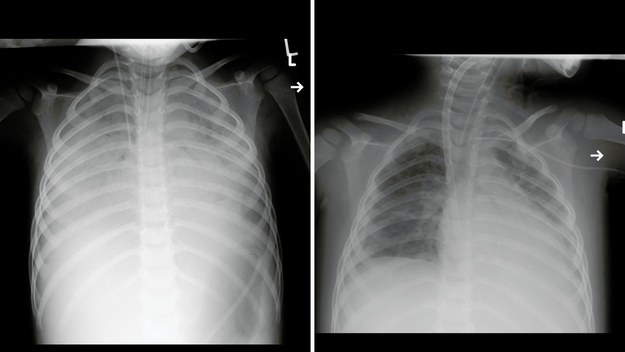 Po lewej stronie zdjęcie płuc po PIMS, a po prawej po ECMO /ICZMP w Łodzi /
