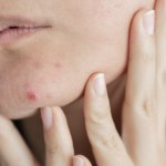 Po tym poznasz, że twoja skóra jest odwodniona. Suche skórki to nie wszystko