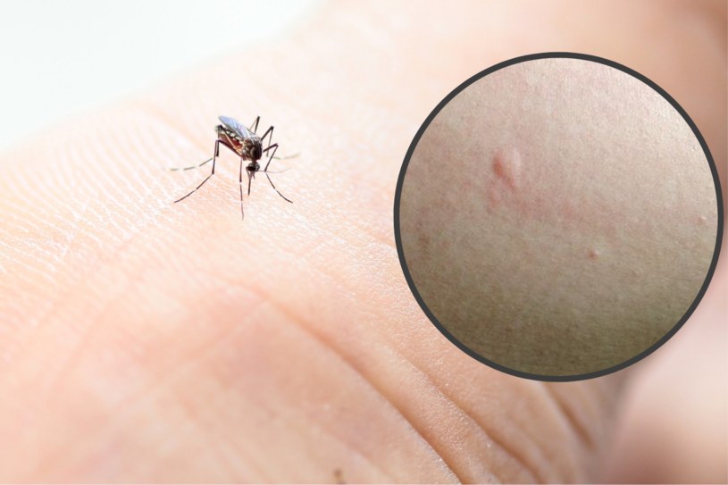 Po ukłuciu przez komara pozostaje ślad w postaci czerwonego, swędzącego bąbla /ProjectManhattan/Wikimedia /123RF/PICSEL