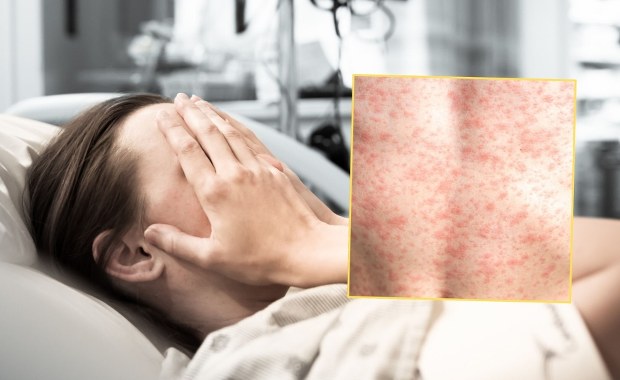 Podejrzewali odrę. Są wyniki badań