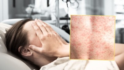 Podejrzewali odrę. Są wyniki badań