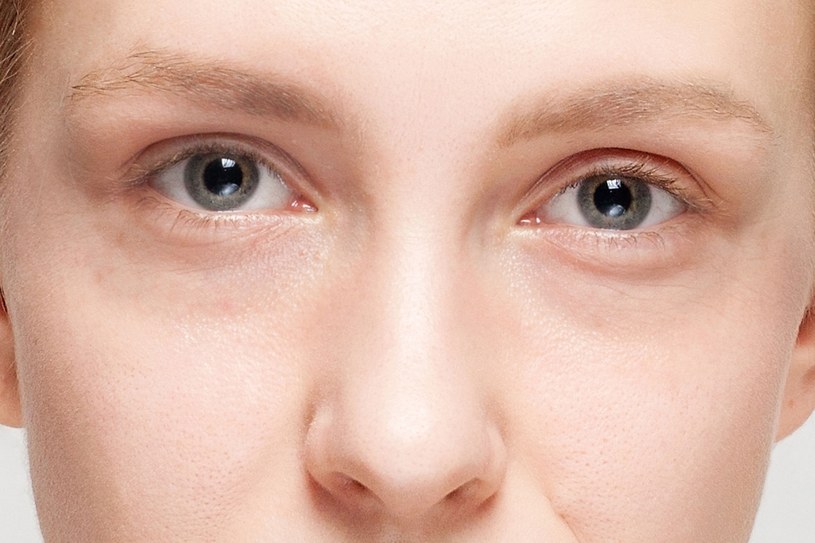 ​Podkrążone oczy i tzw. worki pod nimi najczęściej są wynikiem przemęczenia i niewyspania /123RF/PICSEL