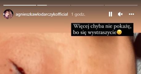 Pokazała fanom zdjęcia z obrażeniami i opatrunkiem /@agnieszkawlodarczykofficial /Instagram