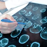 glejak Polacy opracowali nowy sposób podawania leków. Mogą zmienić terapię raka mózgu