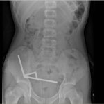 Połknął 200 magnesów z Temu. Ledwo to przeżył