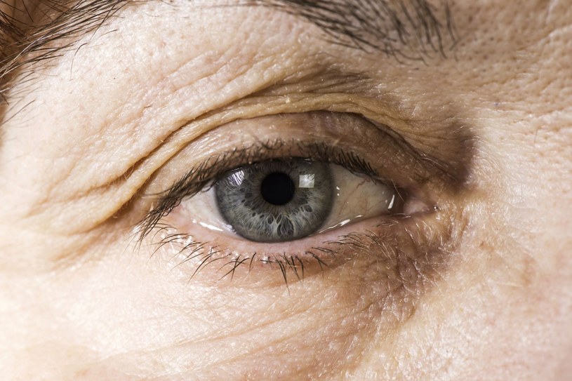 Półpasiec oczny powoduje ból, swędzenie i pieczenie oka. Na powiece pojawia się również wysypka z pęcherzami /123RF/PICSEL