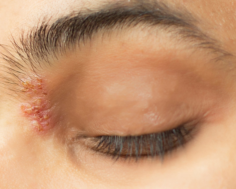Półpasiec oczny powoduje ból, swędzenie i pieczenie oka. Na powiece pojawia się również wysypka z pęcherzami /123RF/PICSEL