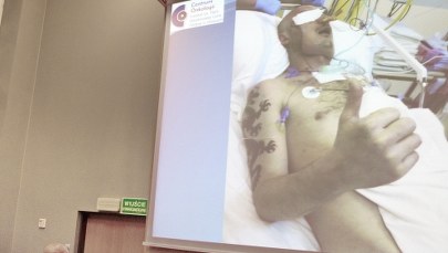 Polski przeszczep twarzy najlepszym zabiegiem na świecie