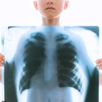 Ponad 180 dzieci przejdzie badania. Miały kontakt z nauczycielką chorą na gruźlicę