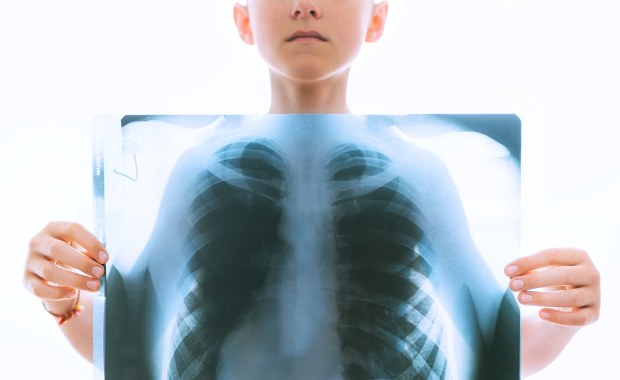 Ponad 180 dzieci przejdzie badania. Miały kontakt z nauczycielką chorą na gruźlicę