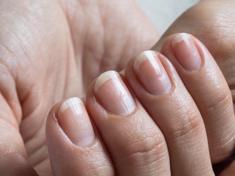 Poprzeczne lub podłużne bruzdy na paznokciach to znak wielu poważnych schorzeń /123RF/PICSEL