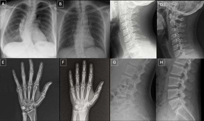 Porównanie prawdziwych zdjęć rentgenowskich (A,C, E, G) i stworzonych przez ChatGPT-4o (B, D, F, H) /Radiological Society of North America (RSNA) /Materiały prasowe