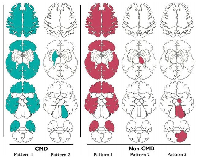 Porównanie wzorców mózgowych osób z CMD i bez CMD /(Franzova et al., Brain, 2023) /domena publiczna