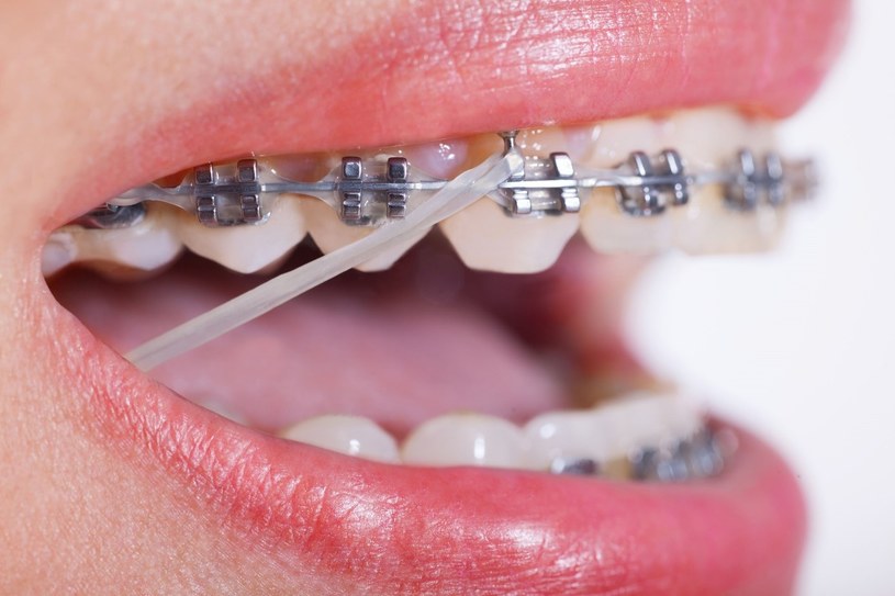 Posiadając aparat ortodontyczny szczotkowanie zębów dwa razy dziennie nie jest wystarczające /123RF/PICSEL