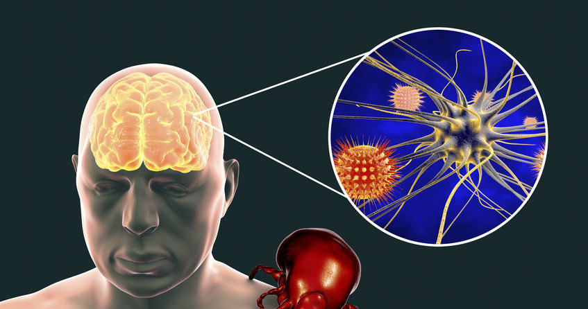 Powikłania neurologiczne /&copy;123RF/PICSEL