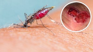 Poznaj komary-zombie. Odkryto gatunek przenoszący mięsożerne bakterie