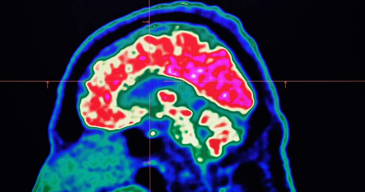 Pozytony wykorzystuje się do uzyskiwania takich obrazów mózgu jak ten - w badaniu pozytonowej tomografii emisyjnej (PET) /AFP