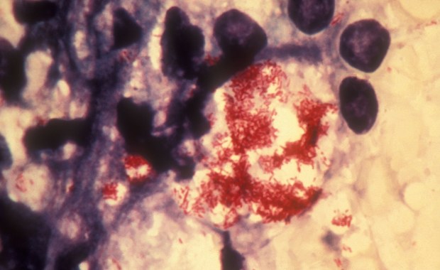 Pracowniczki salonu SPA z trądem. Choroba pojawiła się po ponad 40 latach