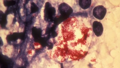 Pracowniczki salonu SPA z trądem. Choroba pojawiła się po ponad 40 latach