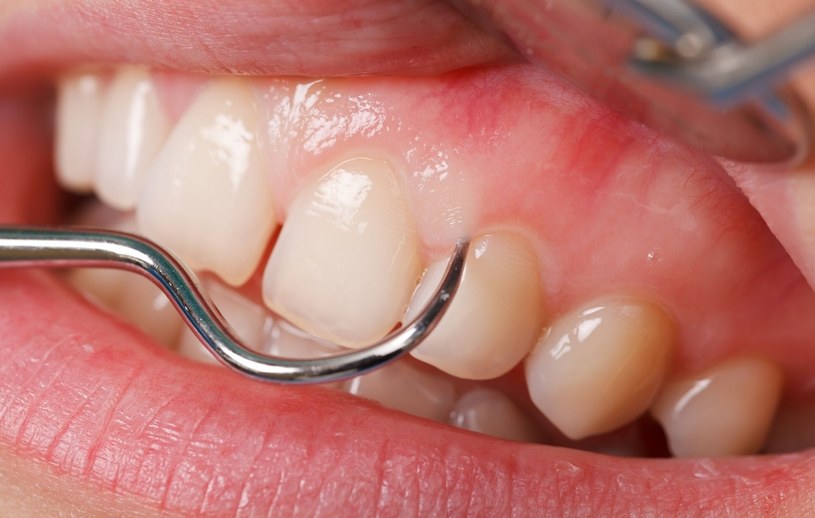 Prawidłowa higiena jamy ustnej zapobiega nie tylko chorobom zębów /123RF/PICSEL