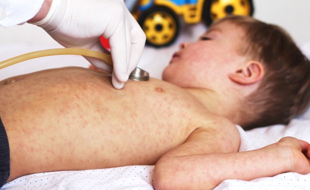 Prawie 100 przypadków odry w Polsce. Ustalenia RMF FM