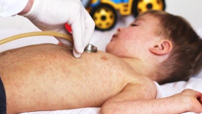 Prawie 100 przypadków odry w Polsce. Ustalenia RMF FM