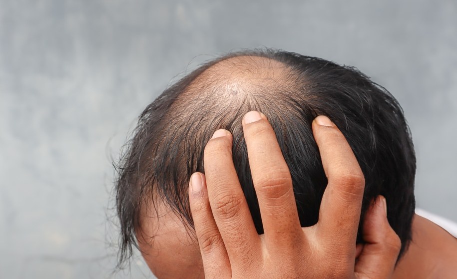 Leczenie łysienia na koszt państwa? Kontrowersyjna propozycja prezydenta