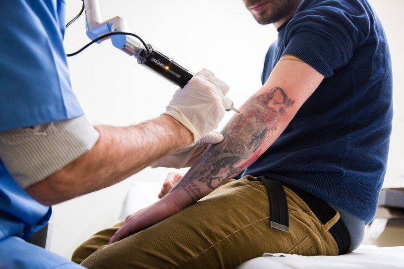 Proces laserowego usuwania tatuażu jest długotrwały, kosztowny i bolesny /East News
