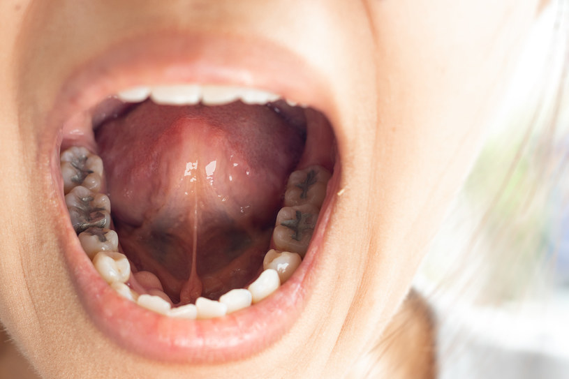 Próchnica oraz choroby dziąseł są konsekwencją zaburzenia flory bakteryjnej w jamie ustnej /123RF/PICSEL
