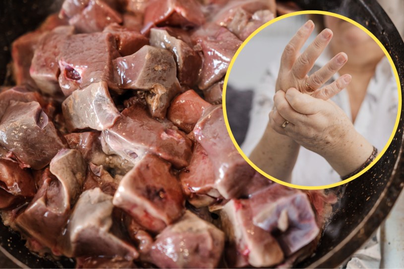 Produkty o wysokiej zawartości puryn zwiększają częstotliwość ataków dny moczanowej /123RF/PICSEL