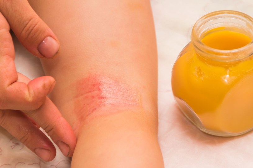 Propolis ma wiele cennych właściwości, m.in. skutecznie łagodzi skórę chorą i podrażnioną /123RF/PICSEL