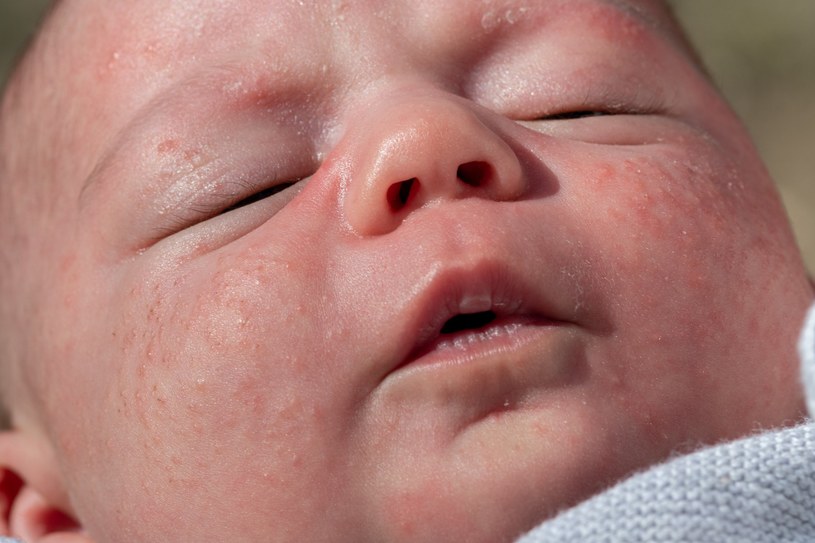Prosaki bardzo często występują u niemowląt, mogą pojawiać się również na błonie śluzowej jamy ustnej /123RF/PICSEL
