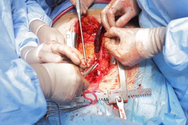 Proteza serca pozwala pacjentom przeczekać czas do transplantacji organu /123RF/PICSEL