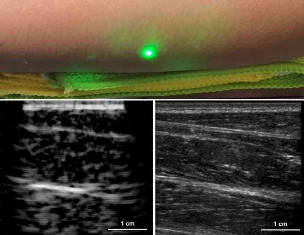 Przedramię oświetlane promieniem lasera ( u góry), obraz USG (po prawej u dołu), obraz uzyskany nową techniką (po lewej u dołu) /Xiang Zhang, Jonathan Fincke, Charles Wynn, Matt Johnson, Robert Haupt, Brian Anthony /Materiały prasowe