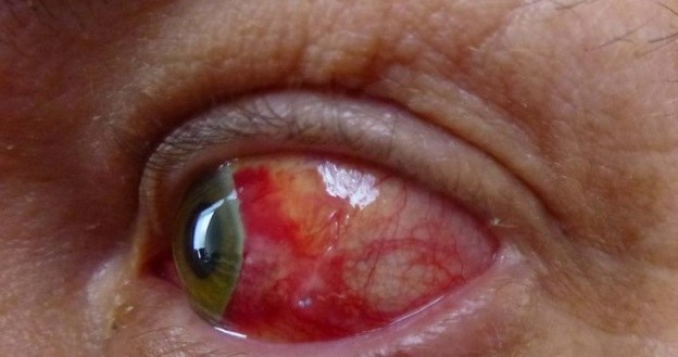 Przekrwienie oczu to jeden z głównych objawów bezsenności /123RF/PICSEL