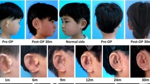 Przełom w medycynie rekonstrukcyjnej - naukowcy wyhodowali nowe uszy