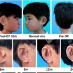 Przełom w medycynie rekonstrukcyjnej - naukowcy wyhodowali nowe uszy