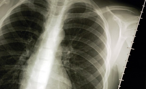 Przełom w walce z rakiem płuc!