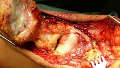 Przełomowa operacja rzepki we Wrocławiu. Pierwszy tego typu zabieg w Europie