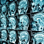 Przełomowe odkrycie o ADHD okazało się błędem? Nowe badania podważają znaną teorię