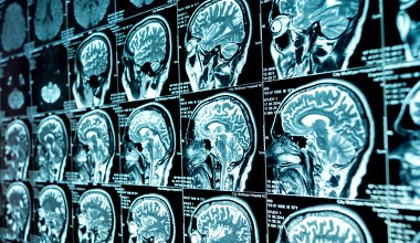 Przełomowe odkrycie o ADHD okazało się błędem? Nowe badania podważają znaną teorię