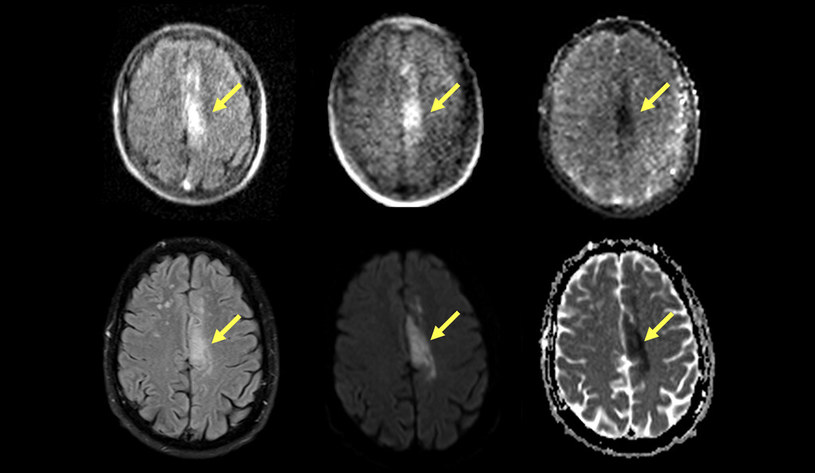 Przenośny rezonans magnetyczny (górny rząd) może wykryć i scharakteryzować udar niedokrwienny mózgu rozpoznany za pomocą standardowego rezonansu magnetycznego (dolny rząd) - odkryli naukowcy z Yale /materiały prasowe