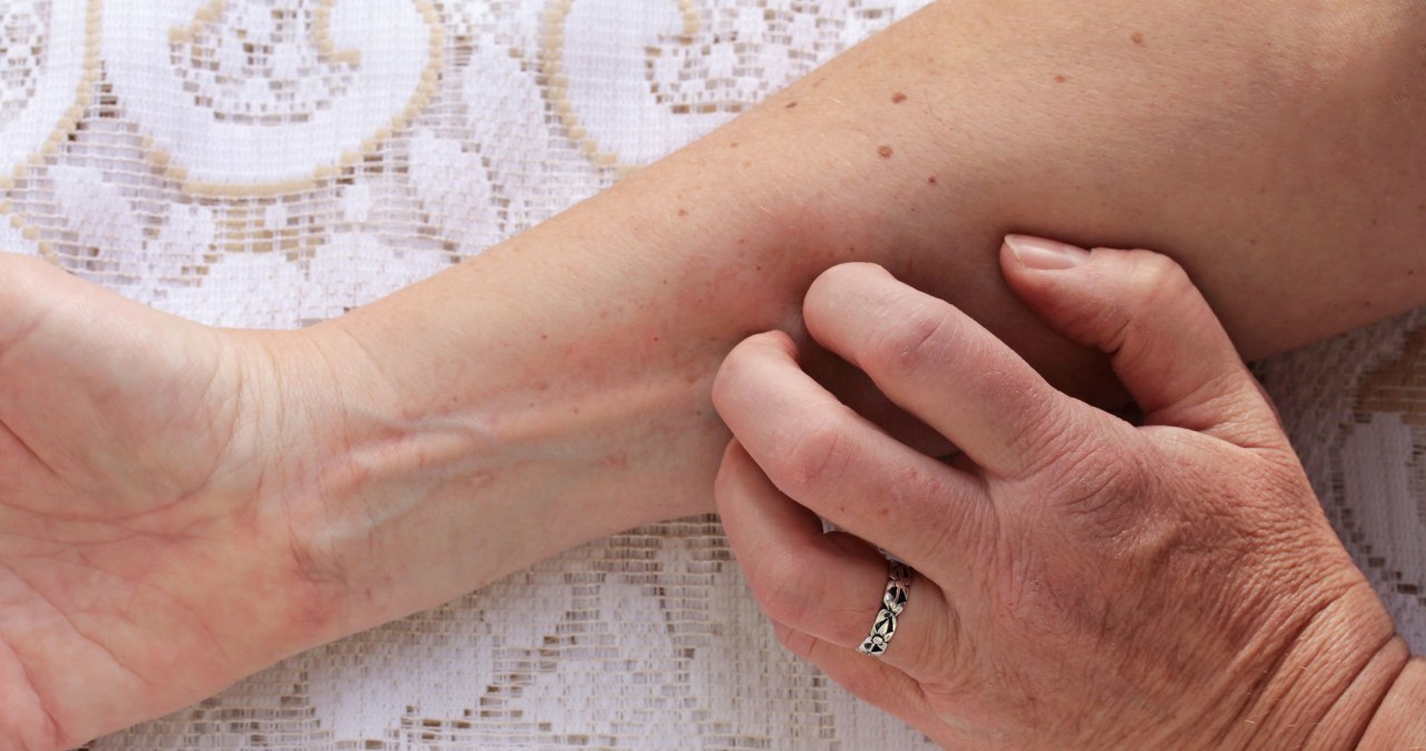 Przesuszona, szorstka skóra skutecznie uprzykrza życie. Stosowanie produktów z emolientami może jednak szybko przywrócić jej gładkość /123RF/PICSEL