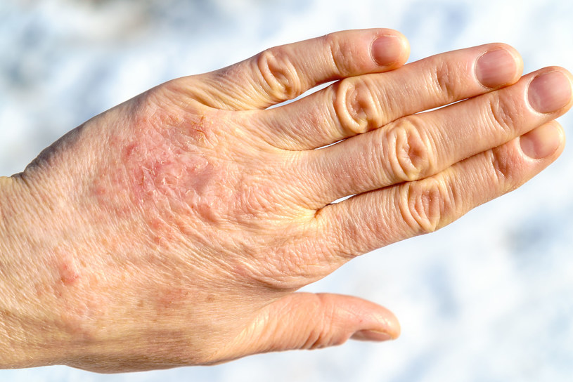 Przesuszone dłonie mogą świadczyć o chorobie. Często są jednak wynikiem eskpozycji na szkodliwe czynniki zewnętrzne /123RF/PICSEL