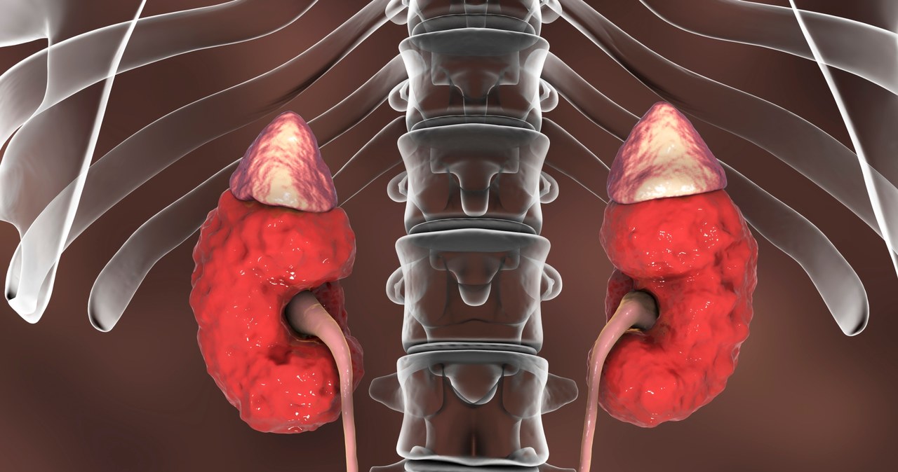 Przewlekła choroba nerek, nawet w zaawansowanej fazie rozwoju, może nie dawać żadnych wyraźnych objawów /123RF/PICSEL