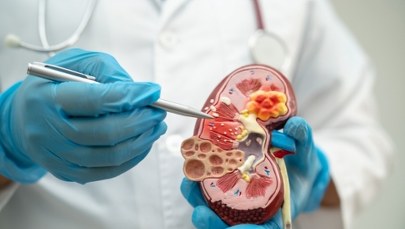 Przewlekła choroba nerek zabija po cichu. Jak się uchronić? 