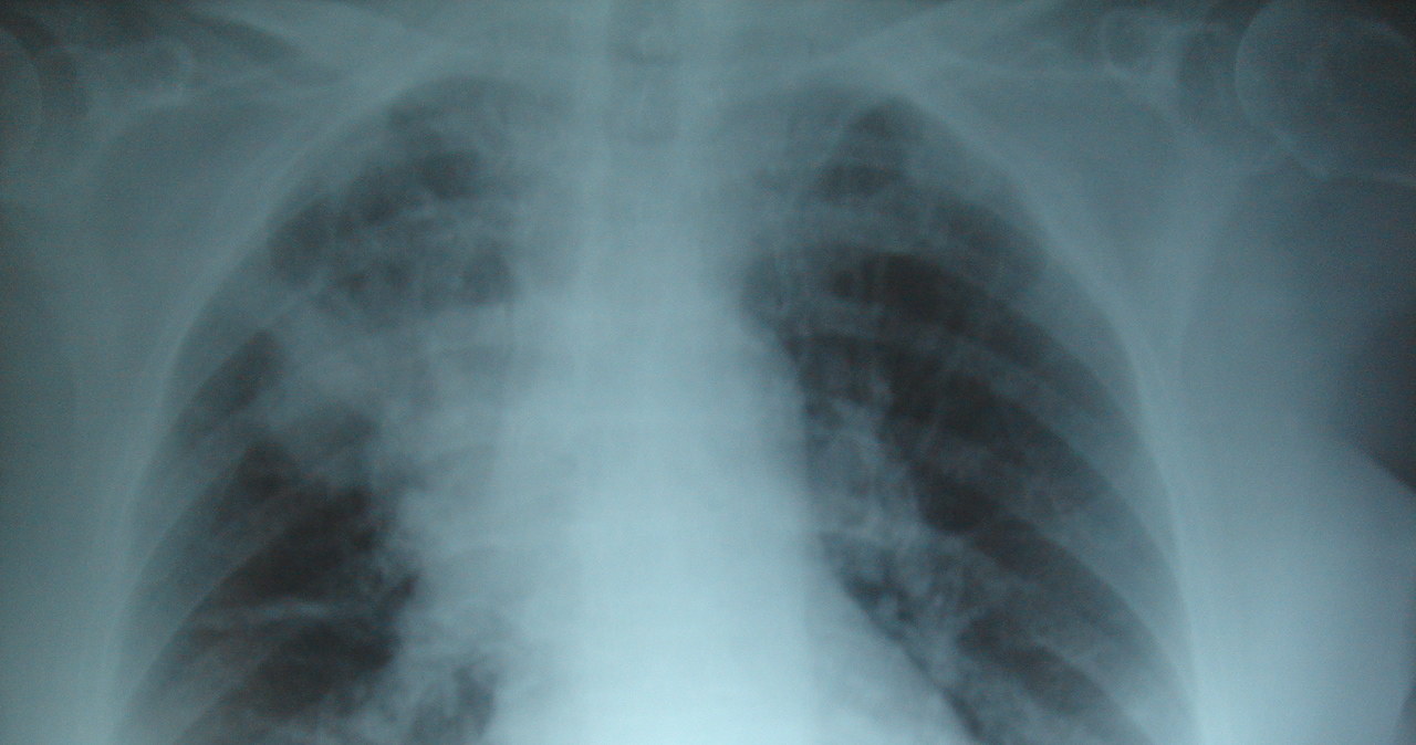 Przewlekłe zapalenie płuc ze zniszczeniem miąższu płucnego u osoby z mukowiscydozą /materiały prasowe