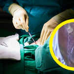 Przez 20 lat żyła z "nożyczkami" w brzuchu. Chirurg zostawił je podczas operacji