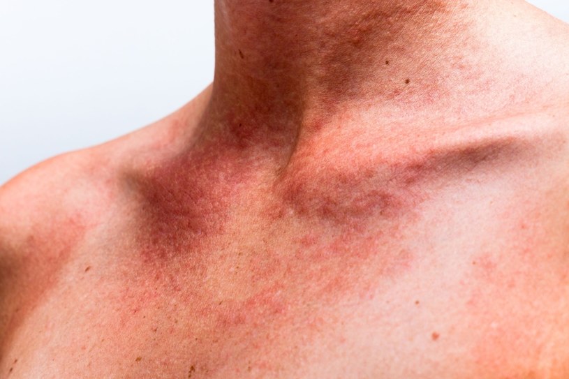 Przy alergii na słońce zmiany najczęściej pojawiają się na dekolcie /123RF/PICSEL