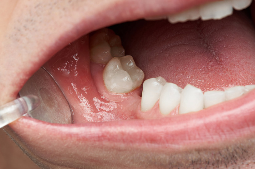 Przy utracie zębów dochodzi do obniżenia linii dziąseł i ich kurczenia się. A to dopiero początek fatalnych zmian! /123RF/PICSEL